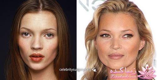 جراحی بینی - جراحی زیبایی